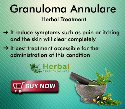 Natural Herbal Remedies for Granuloma Annulare
