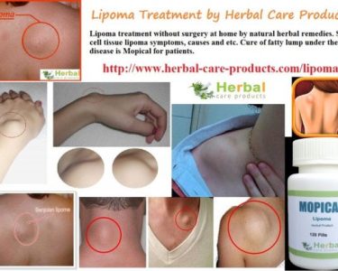 Natural Herbal Remedies for Lipoma