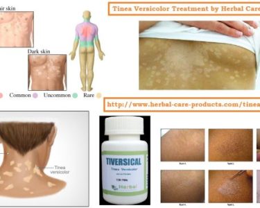 Natural Herbal Remedies for Tinea Versicolor Treatment