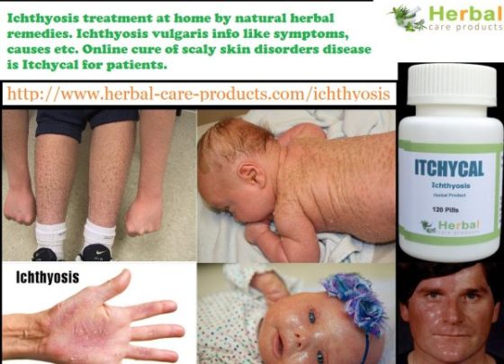 Natural Herbal Treatment for Ichthyosis and Symptoms, Causes