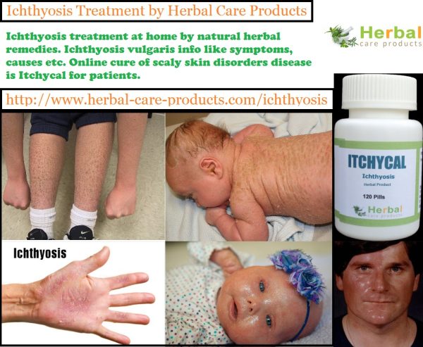 Natural Herbal Treatment for Ichthyosis and Symptoms, Causes