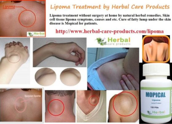 Natural Herbal Treatment for Lipoma and Symptoms, Causes