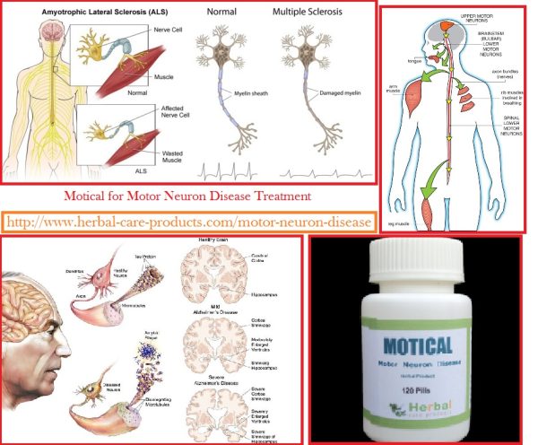 Natural Herbal Treatment for Motor Neuron Disease and Symptoms, Causes