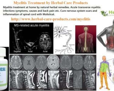 Natural Herbal Treatment for Myelitis and Symptoms, Causes
