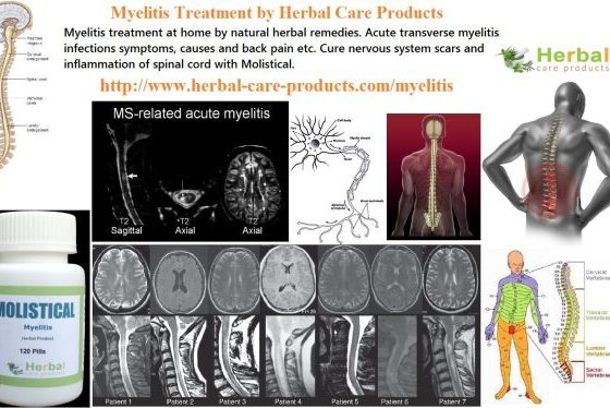 Natural Herbal Treatment for Myelitis and Symptoms, Causes