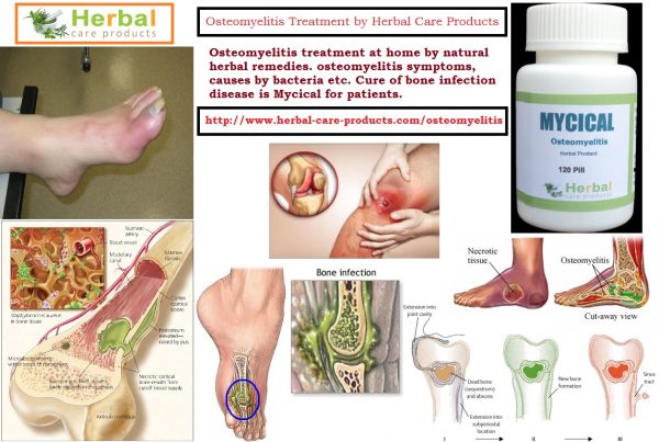 Natural Herbal Treatment for Osteomyelitis and Symptoms, Causes