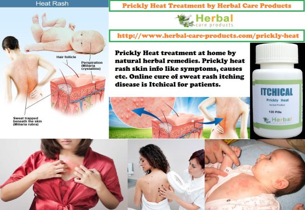 Natural Herbal Treatment for Prickly Heat and Symptoms, Causes