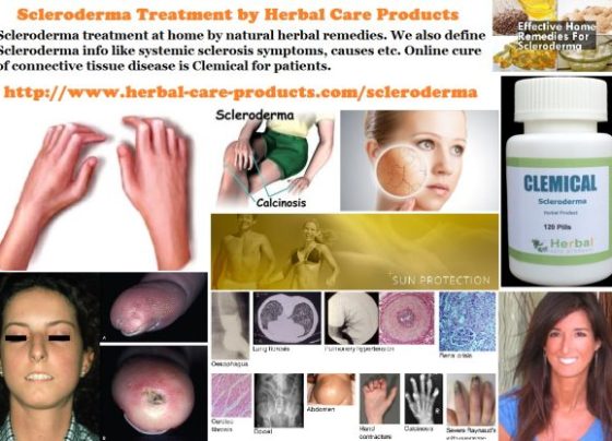 Natural Herbal Treatment for Scleroderma and Symptoms, Causes