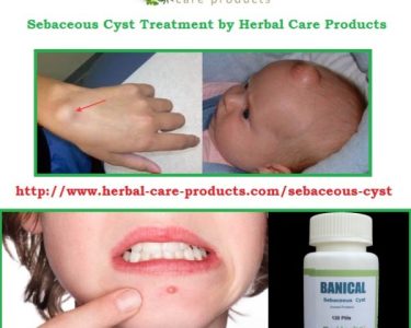Natural Herbal Treatment for Sebaceous Cyst and Symptoms, Causes