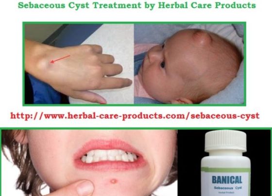 Natural Herbal Treatment for Sebaceous Cyst and Symptoms, Causes