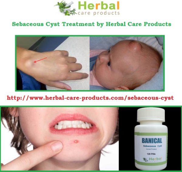 Natural Herbal Treatment for Sebaceous Cyst and Symptoms, Causes