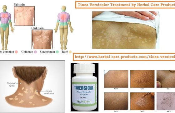 Natural Remedies for Tinea Versicolor, Symptoms & Herbal Treatment