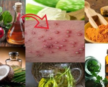 Natural Solutions to Treat Folliculitis Bumps on the Scalp