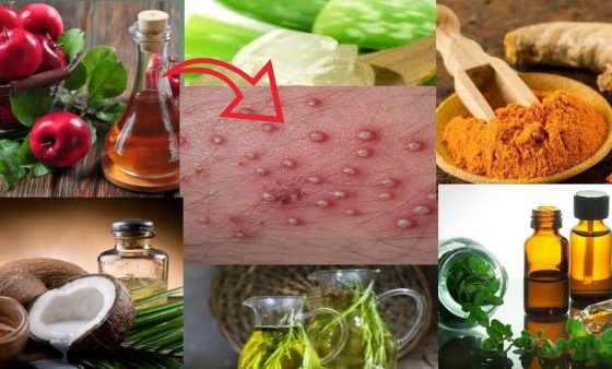 Natural Solutions to Treat Folliculitis Bumps on the Scalp