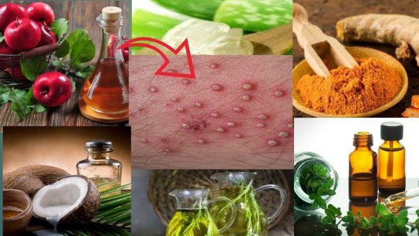 Natural Solutions to Treat Folliculitis Bumps on the Scalp