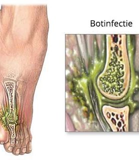 Osteomyelitis – Bone Marrow Infection