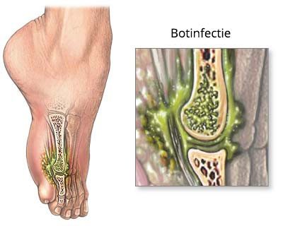 Osteomyelitis – Bone Marrow Infection