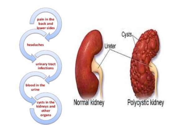 Polycystic Kidney Disease - Enlarged Kidney