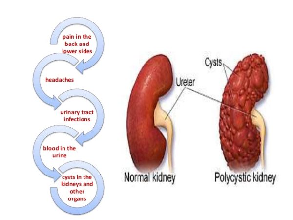 Polycystic Kidney Disease – Enlarged Kidney