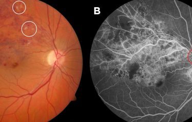 Retinal Vein Occlusion - Optic Neuritis