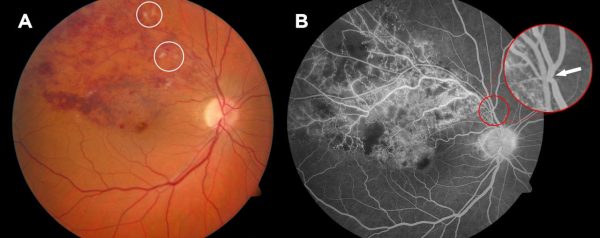Retinal Vein Occlusion – Optic Neuritis