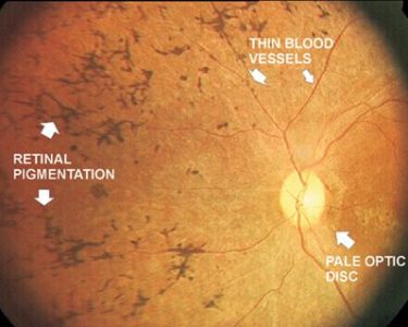 Retinitis Pigmentosa - Vision Impairment Disorder