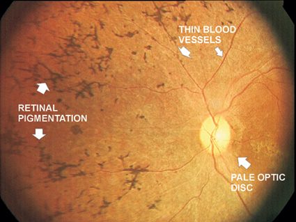 Retinitis Pigmentosa - Vision Impairment Disorder