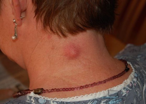 Sebaceous Cyst - Epidermoid Disorder