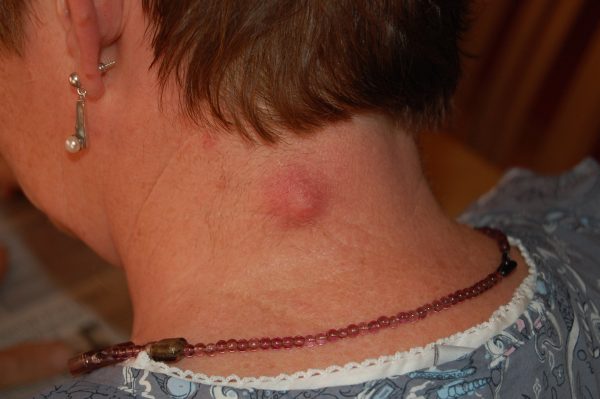 Sebaceous Cyst – Epidermoid Disorder