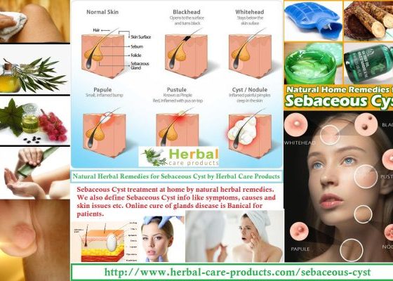 Sebaceous Cyst Natural Herbal Remedies for Skin Glands