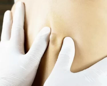 Sebaceous Cyst Treatment Non Surgical