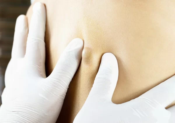 Sebaceous Cyst Treatment Non Surgical: What You Need To Know