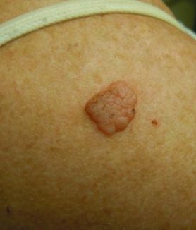 Seborrheic Keratosis - Melanoma Skin Cancer