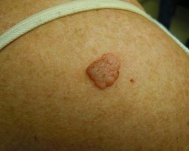 Seborrheic Keratosis - Melanoma Skin Cancer