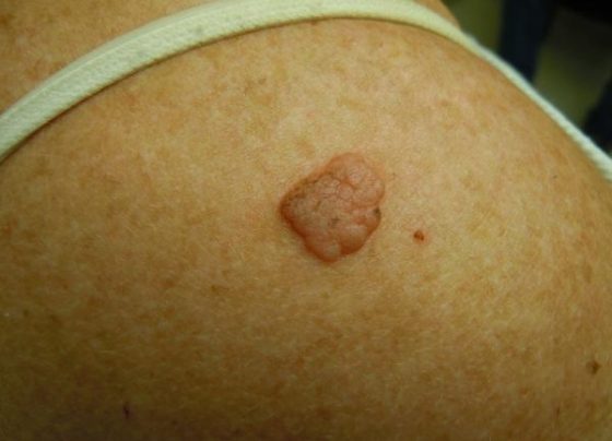 Seborrheic Keratosis - Melanoma Skin Cancer