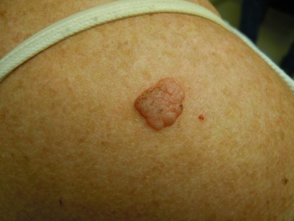 Seborrheic Keratosis – Melanoma Skin Cancer