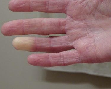 Some Treatment Options for Scleroderma