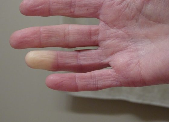 Some Treatment Options for Scleroderma
