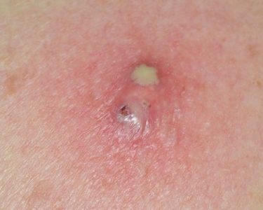 The Basics of Infected Sebaceous Cyst Removal