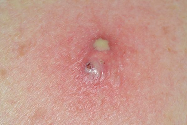 The Basics of Infected Sebaceous Cyst Removal