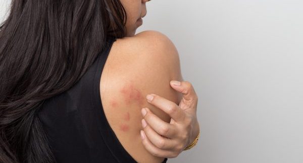 The Benefits of a Granuloma Annulare Diet