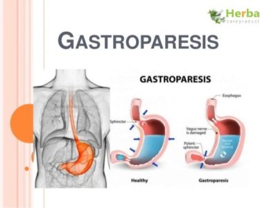 The Best Medications for Gastroparesis Treatment