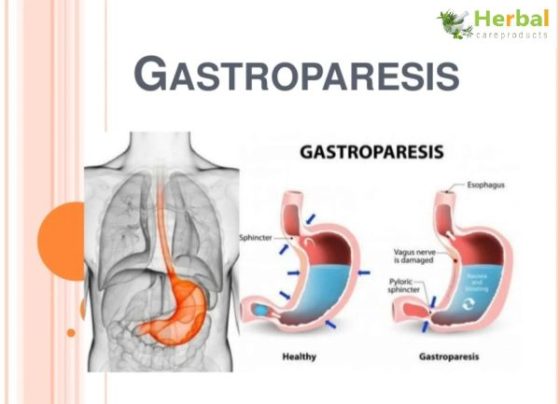 The Best Medications for Gastroparesis Treatment