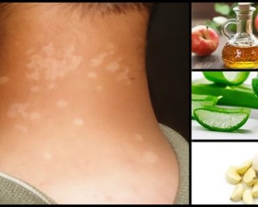 Tinea Versicolor Home Remedies and Natural Treatment