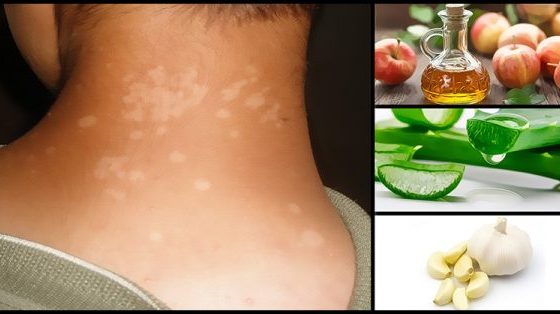 Tinea Versicolor Home Remedies and Natural Treatment