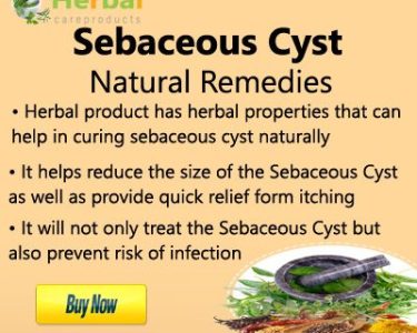 Top 14 Home Remedies To Treat Sebaceous Cysts