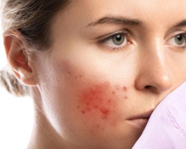 Top Natural Remedies for Battling Bacterial Folliculitis