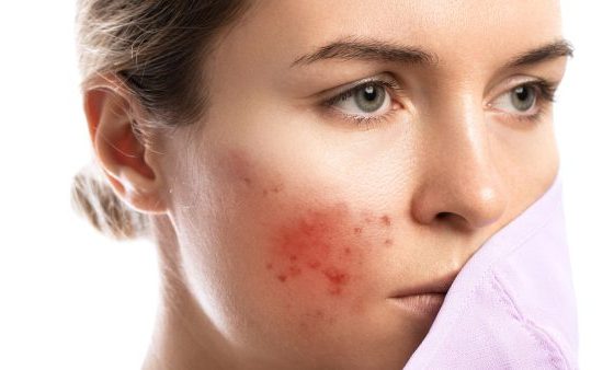 Top Natural Remedies for Battling Bacterial Folliculitis