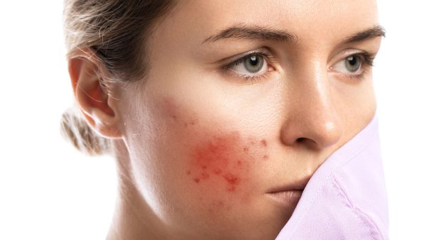 Top Natural Remedies for Battling Bacterial Folliculitis : From Tea Tree Oil to Turmeric