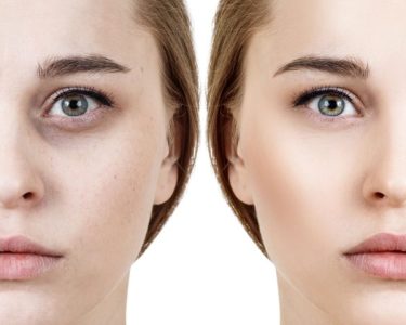 Top Tips to Care for Dark Circles and Sunken Eyes